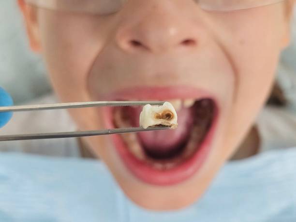 Best Urgent Care for Lost Fillings or Crowns in East Palestine, OH